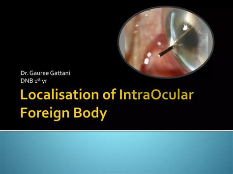 Intra Ocular Foreign Body Ppt