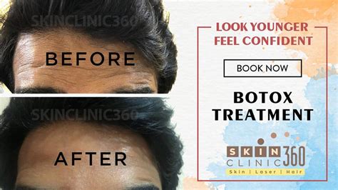 Best Skin Specialist In Pimple Saudagar Skin Clinic Best