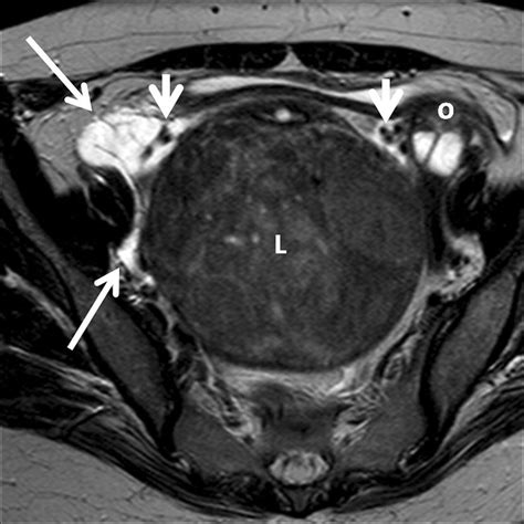 A 47 Year Old Patient With A Large Leiomyomatous Uterus Treated With Download Scientific