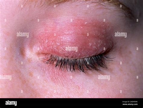 Eczema on eyelid. Close-up of an eczema rash on the eyelid of an 18