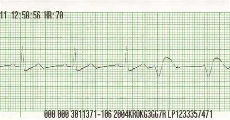 Float Nurse Ekg Rhythm Strips 18 Ventricular Ectopy 1