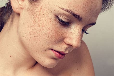 ¿cómo Tratar Las Manchas En La Piel Por El Sol Skinexpert