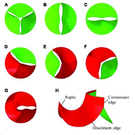 | Geometries of TAV and BAV (A) TAV, (B) Type 0 a-p, (C) Type 0 lat ...