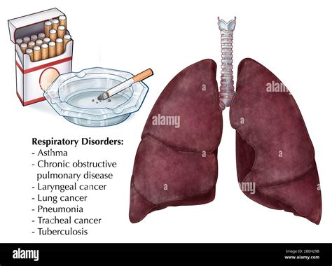 Lung Disease Because Of Smoking