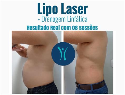 Lipo Laser A Lipoaspira O Sem Dor Incorpore Est Tica Avan Ada