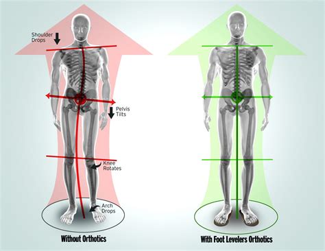 Breaking Study Validates Foot Levelers Custom Orthotics Significantly