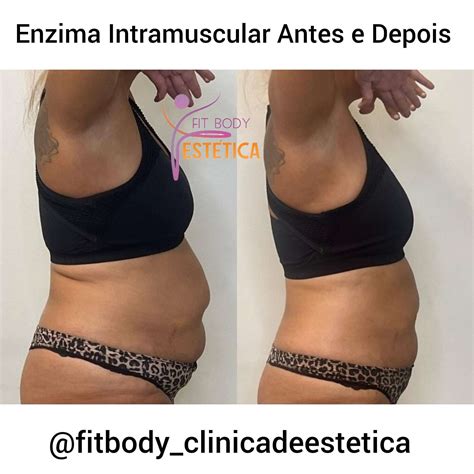 Qual A Melhor Enzima Intramuscular Para Emagrecer - Enzima Intramuscular Antes e Depois - Dra.Sacha Silveira
