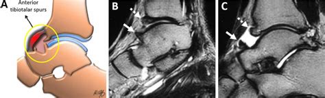 Ankle impingement syndrome causes, symptoms, diagnosis & treatment