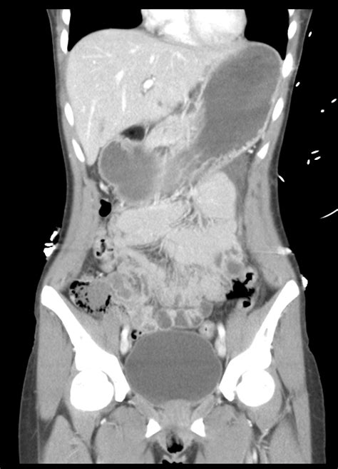 File Abdominal Multi Trauma Devascularised Kidney And Liver Spleen