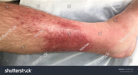 Cellulitis Left Leg Stock Photo 1282881283 Shutterstock