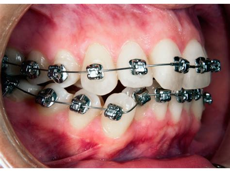 Yetişkinlerde Ortodonti - Mersin Ortodonti Uzmanı