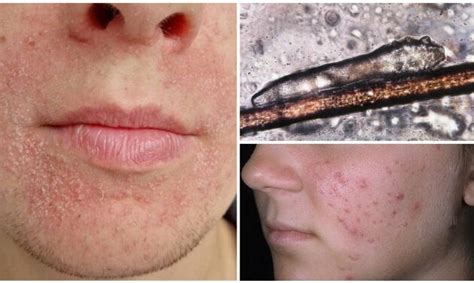 Демодекоз - как лечить подкожный клещ?