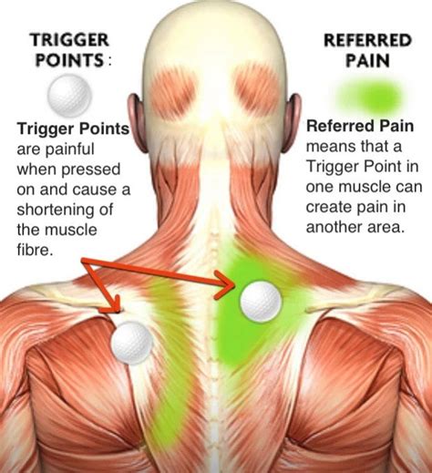 Everything You Need To Know About Trigger Point Massage Therapy