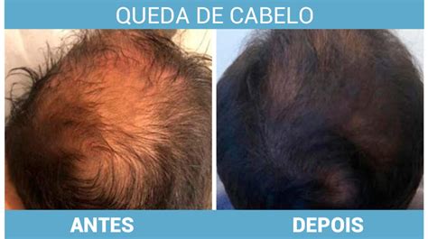 Mmp Capilar Antes E Depois - Essential Guide To MMP Scalp Microinfusion | Skin Specialists In Rio De ...