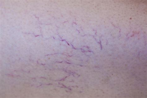 blood vessels  skin