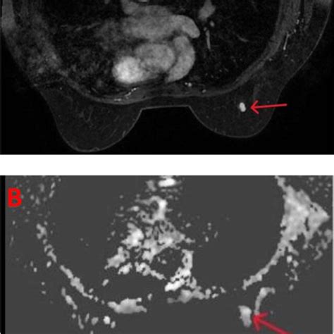 Ultrasound Aspect Of Breast Cysts A Simple Cyst Anechoic Image With
