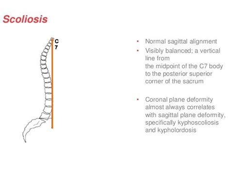 Scoliosis Lecture By Professor Dr Md Shah Alam