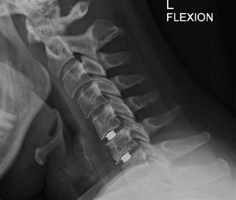 Cervical Arthroplasty Considerations Top New York Cervical Spine Surgeon