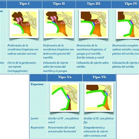 Clasificación De La Timpanoplastia Fuente Timpanoplastia Sociedad
