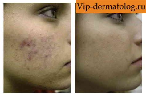 Симптомы демодекоза на лице. Демодекоз лица: симптомы, фото