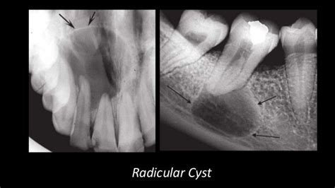 Cysts