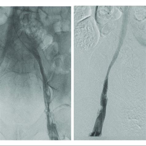 Venogram Of Bilateral Femoral And Iliac Veins After Treatment With Ekos