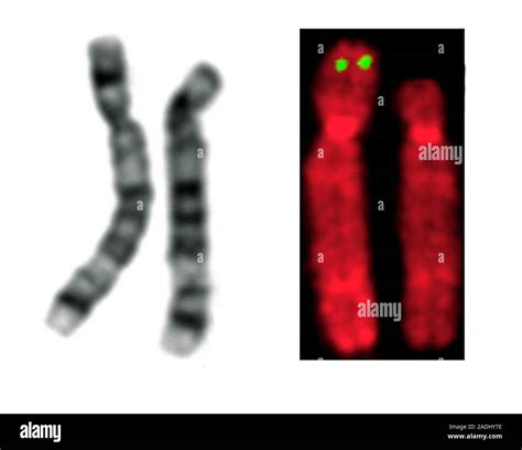 Cri du chat syndrome chromosomes. Fluorescence in situ hybridisation ...