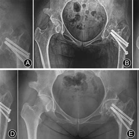 Patient S Orthopedic Pelvic Radiographs Month A Months B