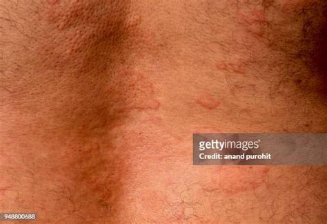 Nettle Rash Photos Photos And Premium High Res Pictures Getty Images