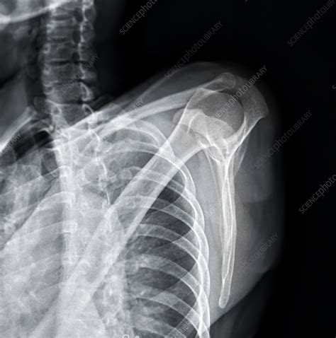 Fractured shoulder, X-ray - Stock Image - F037/5545 - Science Photo Library