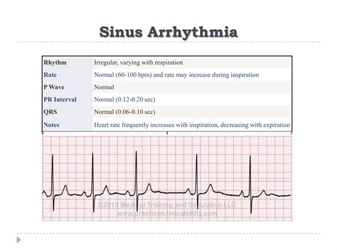Ecg Or Ekg Sample Strips Ms Cardiovascular Ppt