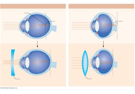 Eye Disorders Diagram | Quizlet