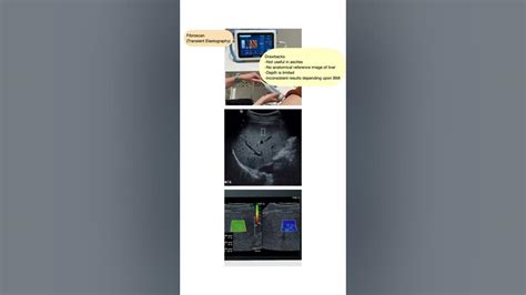 Fibroscan: How I do it? #safdarjunghospital #NEETPG #radiologycourse # ...