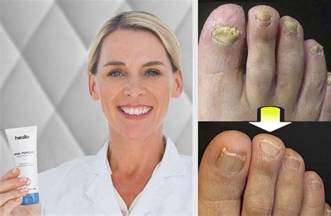 Healio Nail Fungus Treatment Reviews