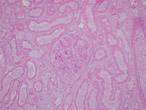 Laboratorij Za Virtualnu Mikroskopiju Slika 3 Infarkt Bubrega Mikro
