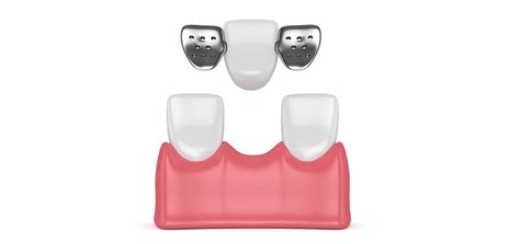 Maryland Bridge Procedure Cost Pros And Cons The Dental Roots