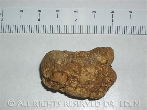 Gallstone Pictures Gallery See Images Of Real Gallstones Passed