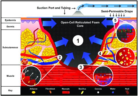 Vac Mechanisms Of Action An Open Cell Reticulated Foam Is Placed