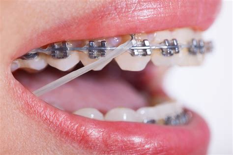 How Braces Design Has Evolved - Belmar Orthodontics