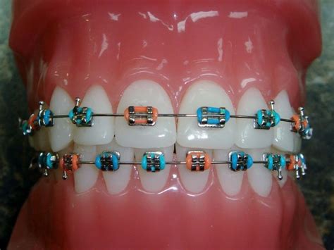 Cool Braces Colors Combinations