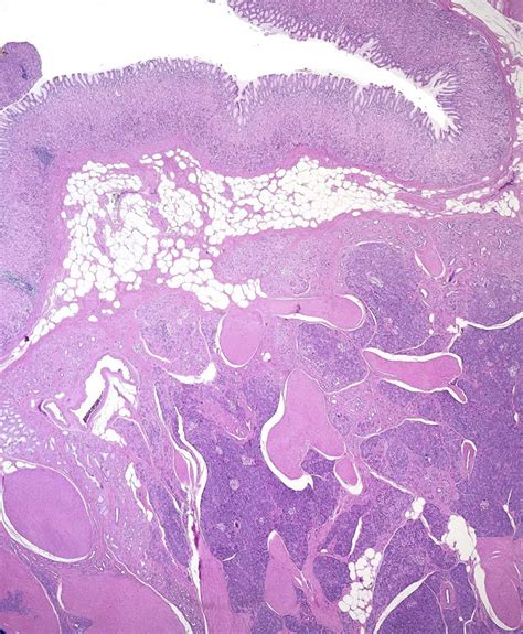 Gastric Polyps Diagnostic Histopathology