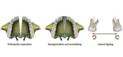 Rapid Maxillary Expansion Rme What Is It All About Orthodontics In