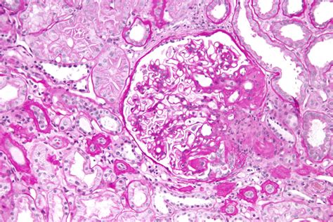 Nephrotic Syndrome Renal Medbullets Step 1