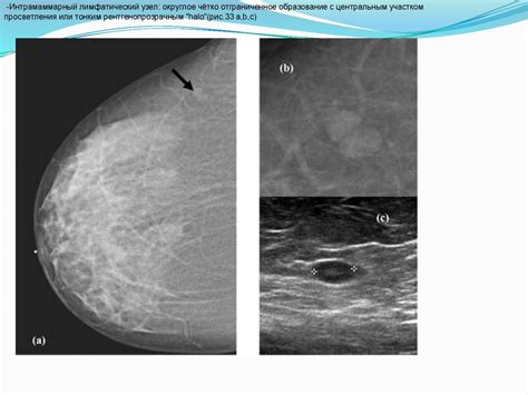 Анатомия и рентгенологические методики исследования молочных желез ...