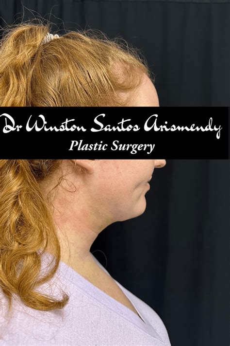 Double Chin Lipo Dr Winston Santos Arismendy Plastic Surgery