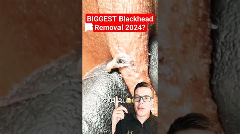Unbelievable Blackhead Removal 2024: The Year's Biggest Breakthrough - y3s24j2