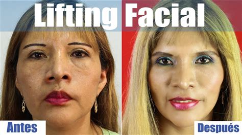 Rejuvenecimiento Del Rostro Antes Y Despues Caso Real De Lifting