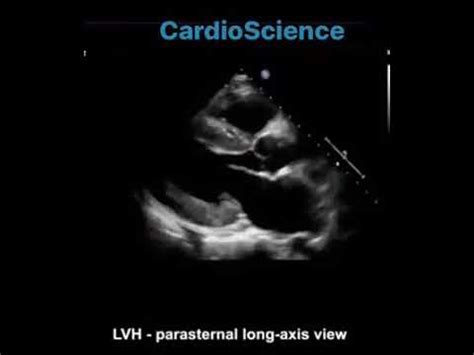 Ecocardiograma planos paraesternal eje largo corto y apical 4 cámaras