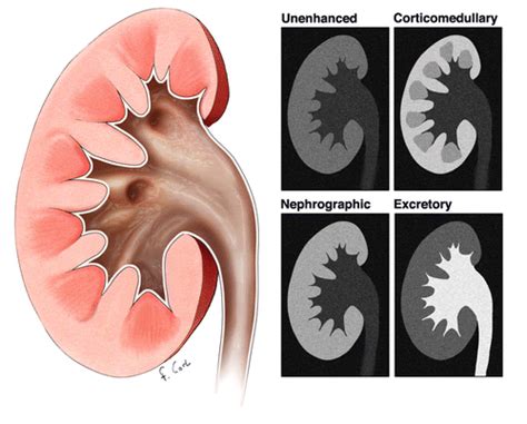 CT Scan Tips & Protocols: Renal CT different phases of contrast enhancement