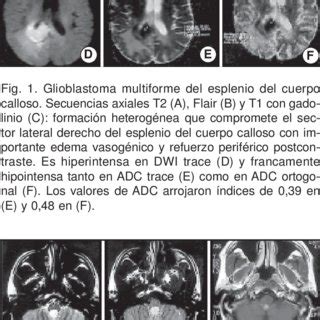 PDF Utilidad del Mapa ADC en la Caracterización de Tumores Encefálicos